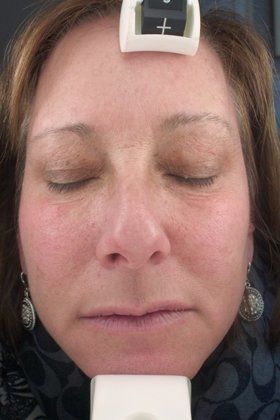 IPL Photofacial Before And After Patient 13