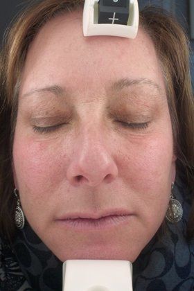 IPL Photofacial Before And After Photo