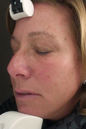 IPL Photofacial Before And After Photo