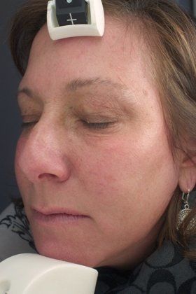 IPL Photofacial Before & After Image
