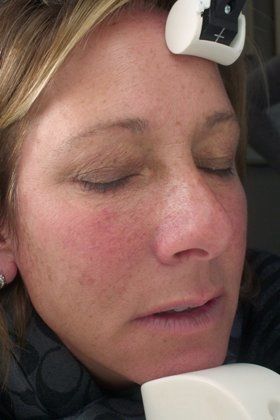 IPL Photofacial Before And After Photo