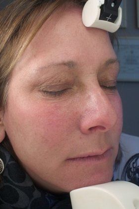 IPL Photofacial Before & After Image