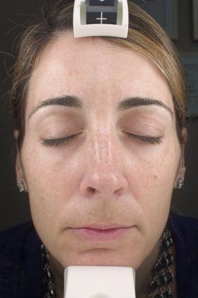 IPL Photofacial Before And After Photo