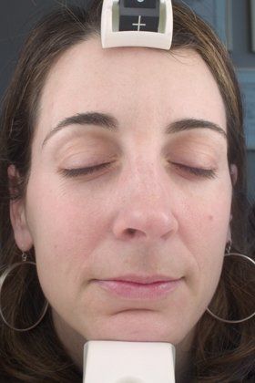 IPL Photofacial Before And After Patient 14