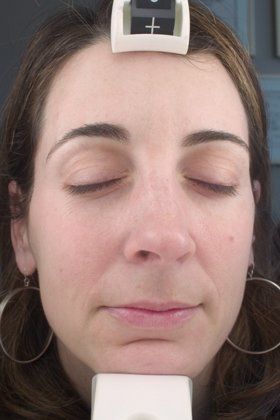 IPL Photofacial Before & After Image