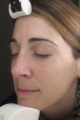 IPL Photofacial Before And After Photo