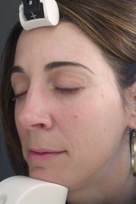 IPL Photofacial Before And After Photo