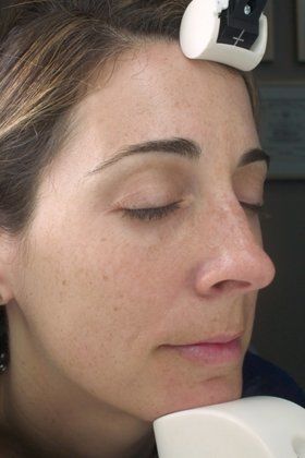 IPL Photofacial Before And After Photo