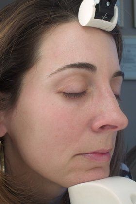 IPL Photofacial Before And After Photo