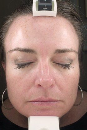 IPL Photofacial Before And After Photo