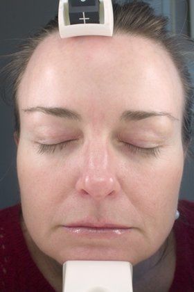 IPL Photofacial Before And After Photo