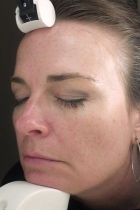 IPL Photofacial Before And After Photo