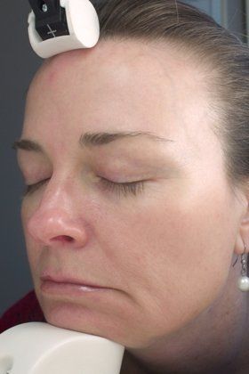 IPL Photofacial Before And After Photo