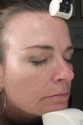 IPL Photofacial Before And After Photo