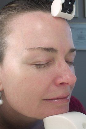 IPL Photofacial Before And After Photo