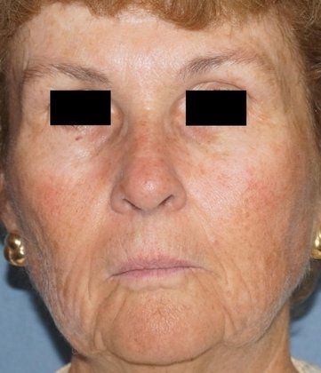 Laser Facial Rejuvenation Before And After Photo