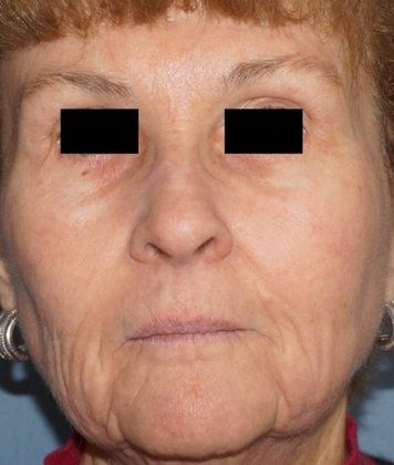 Laser Facial Rejuvenation Before And After Photo