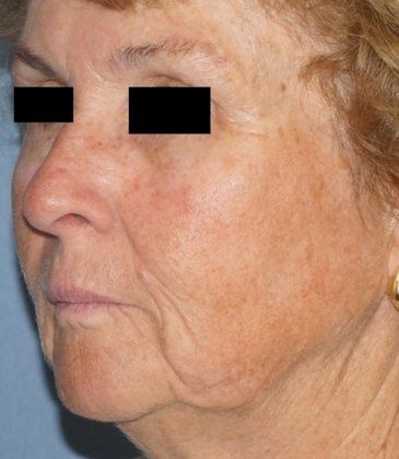 Laser Facial Rejuvenation Before And After Photo