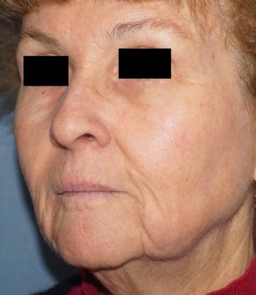 Laser Facial Rejuvenation Before And After Photo