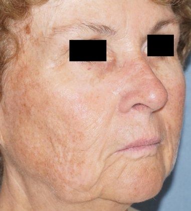 Laser Facial Rejuvenation Before And After Photo