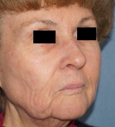 Laser Facial Rejuvenation Before And After Photo