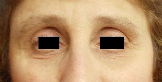 Laser Facial Rejuvenation Before And After Photo