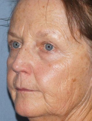 Laser Facial Rejuvenation Before And After Photo