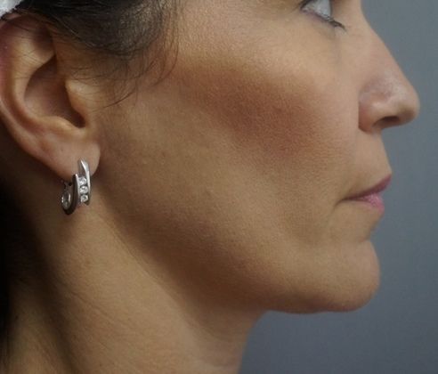 Non-Invasive Skin Tightening Before And After Patient 2