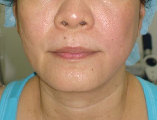 Non-Invasive Skin Tightening Before And After Patient 11