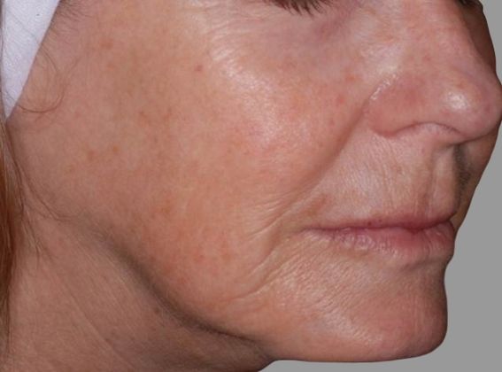 Non-Invasive Skin Tightening Before And After Patient 12