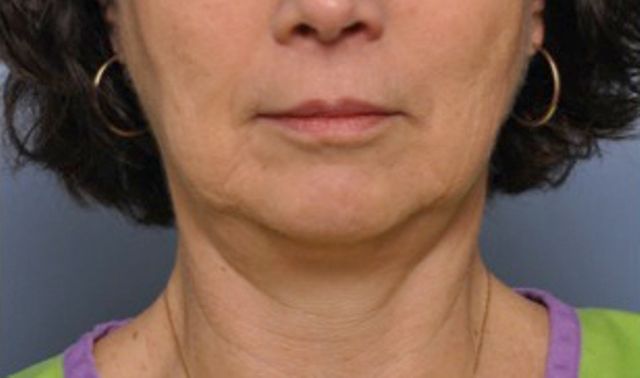 Non-Invasive Skin Tightening Before And After Photo