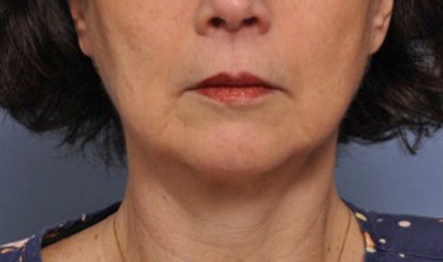 Non-Invasive Skin Tightening Before And After Patient 13