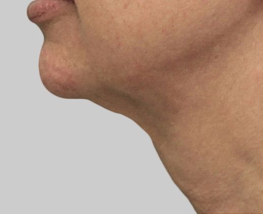 Non-Invasive Skin Tightening Before And After Patient 14