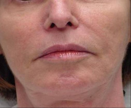 Non-Invasive Skin Tightening Before And After Patient 15