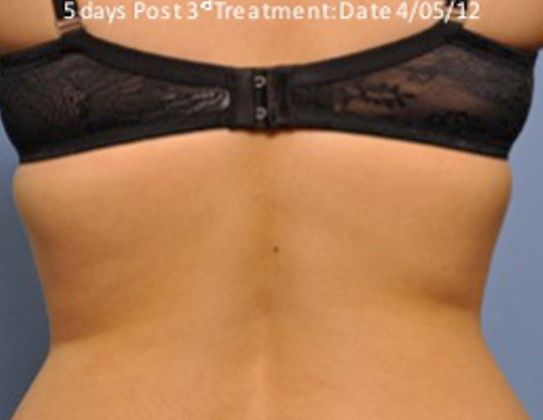 Non-Invasive Skin Tightening Before And After Photo