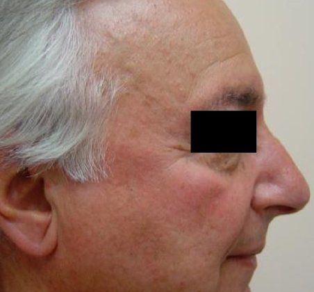 IPL Photofacial For Men Before And After Photo