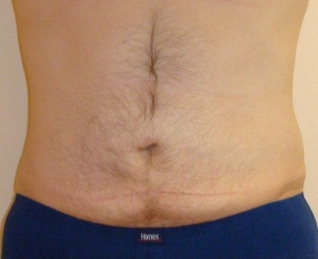 Liposuction for Men Before And After Patient 1