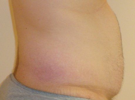Liposuction For Men Before And After Photo