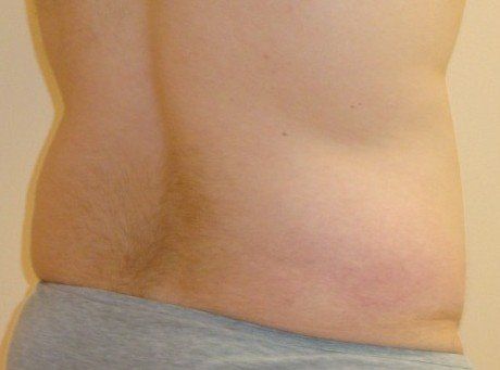 Liposuction For Men Before And After Photo