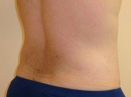 Liposuction For Men Before And After Photo