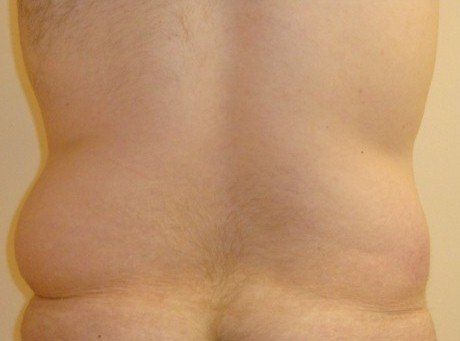 Liposuction For Men Before And After Photo