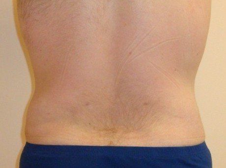 Liposuction For Men Before And After Photo