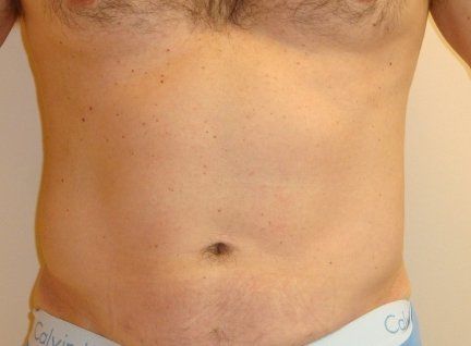 Liposuction for Men Before And After Patient 2