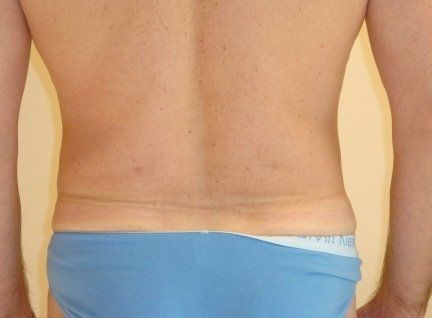 Liposuction For Men Before And After Photo