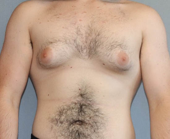 Male Breast Reduction Before And After Photo