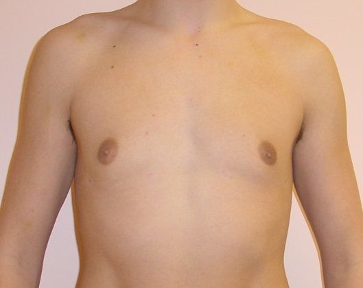 Male Breast Reduction Before And After Patient 1