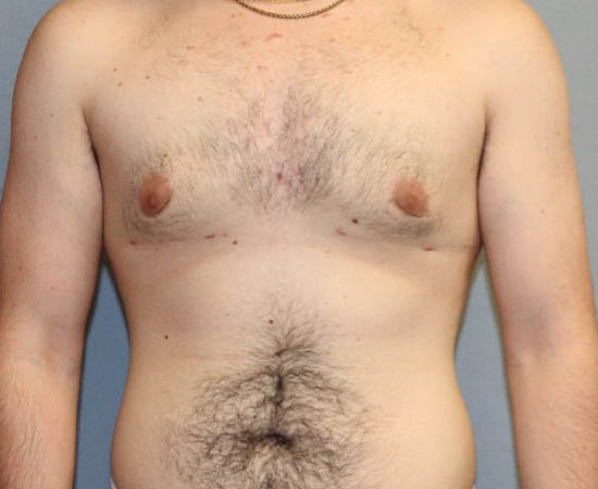 Male Breast Reduction Before And After Photo