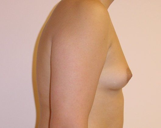 Male Breast Reduction Before And After Photo