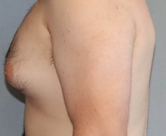 Male Breast Reduction Before And After Photo