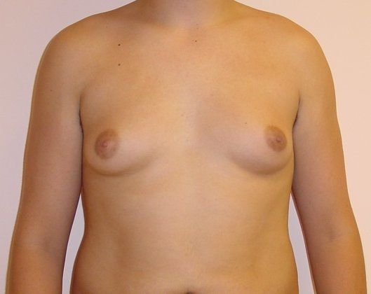 Male Breast Reduction Before & After Image